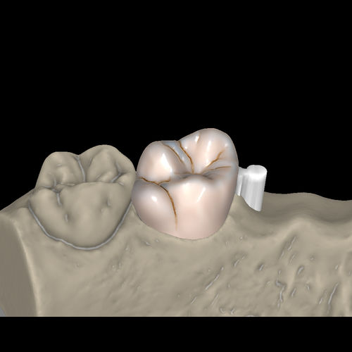 Modulo software per laboratorio dentale - Attachments - Zirkonzahn - CAD / FAO / di fabbricazione di protesi