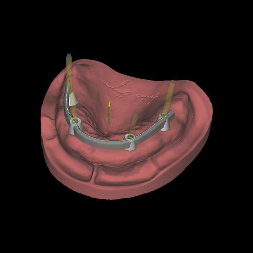 Modulo software per laboratorio dentale - Bars - Zirkonzahn - CAD / di progettazione di protesi dentale / FAO