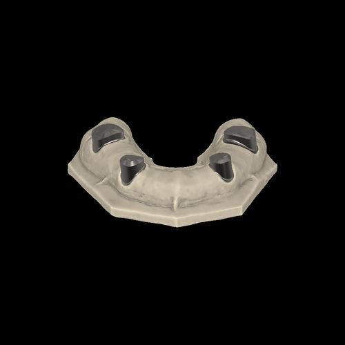 Modulo software per laboratorio dentale - Telescopic crowns - Zirkonzahn - CAD / di progettazione di protesi dentale / FAO