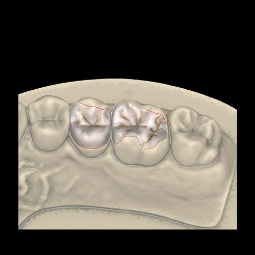 Modulo software di progettazione di protesi dentale - Inlays/Onlays/Veneers - Zirkonzahn - FAO / CAD / per laboratorio dentale
