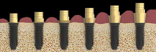 Pilastro dentale per impianto a spirale - K80  - Zirkonzahn - in titanio / conico / interno