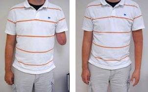 Protesi estetica per braccio - Boston Orthotics + Prosthetics - per adulti / pediatrica