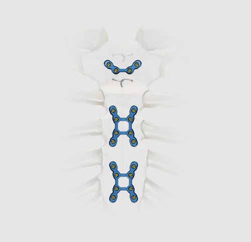Placca di compressione per sterno - SternaLock® Blu - Zimmer Biomet - bloccata / in titanio