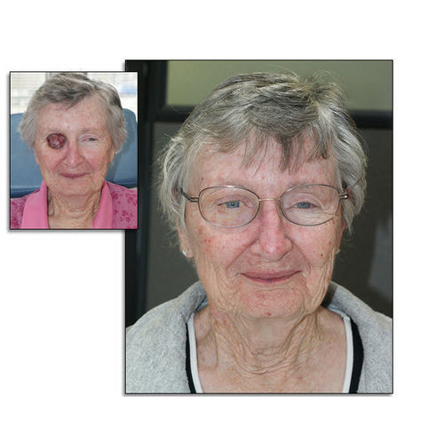 Protesi estetica orbitale - RealLifeSkin™ - RealLifeSkin - per adulti