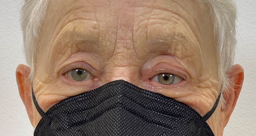 Protesi estetica oculare - Scleral Shells - The Anaplastology Clinic - per adulti