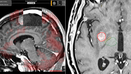 Software di pianificazione del trattamento - Elements - Brainlab - medico / di oncologia / automatizzato