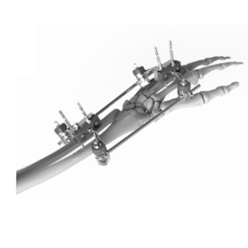 Fissatore esterno per polso - 206301 - SOFEMED International - tubolare / per adulti
