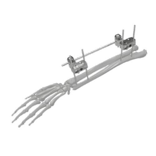 Fissatore esterno per ulna - 206302 - SOFEMED International - per radio / tubolare / per adulti