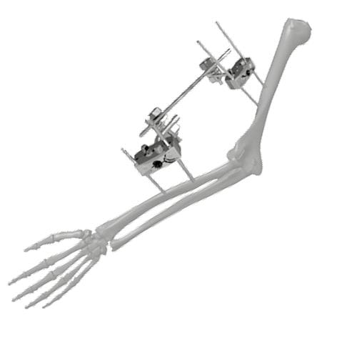 Fissatore esterno per gomito - 206303 - SOFEMED International - tubolare / per adulti