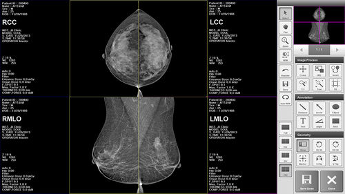 Software per mammografia - BRESTATION LITE - MEDI-FUTURE - di analisi delle immagini / di gestione / diagnostico