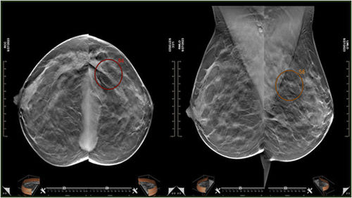 Software medicale CAD - MEDI-FUTURE - per mammografia / di oncologia / per screening del tumore al seno