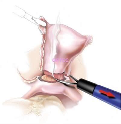 Elettrodo laparoscopico - LapLoop  - OPTEC Endoscopy Systems - ad ansa a filo / monopolare