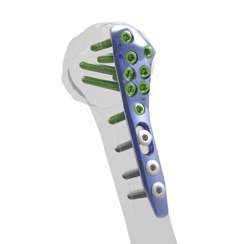 Placca di compressione per omero - Alians™ - Enovis Surgical - prossimale / bloccata / in metallo