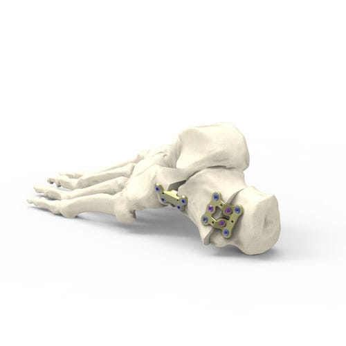 Placca per osteotomia per calcagno - FDTSDN1 - Newclip Technics - in metallo