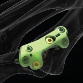 Placca per artrodesi per articolazione metatarso-falangea - MTP  - Newclip Technics - distale / prossimale / bloccata