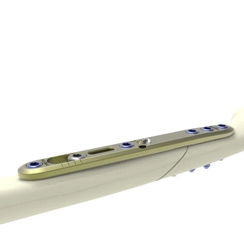Placca per osteotomia per ulna - HTSIS2 - Newclip Technics - mediale / bloccata / non bloccata