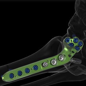 Placca per artrodesi per articolazione metatarso-falangea - ACTIV FUSE - Newclip Technics - anterolaterale / in metallo