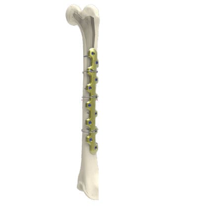 Placca per osteotomia per femore - PERIACTIV - Newclip Technics - bloccata / in metallo