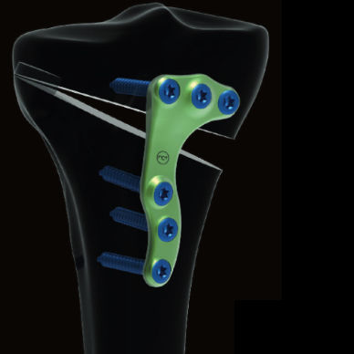 Placca per osteotomia per tibia - Activmotion S   - Newclip Technics - prossimale / laterale / in metallo