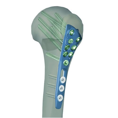 Placca di compressione per omero - STGPSS1 - Newclip Technics - prossimale / bloccata / non bloccata