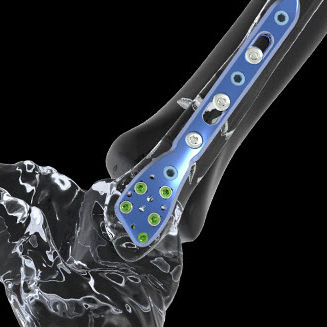 Placca di compressione per tibia - FTS1 - Newclip Technics - per fibula / per caviglia / per malleolo