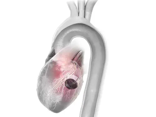 Moncone Angolato Anatomico Concavo 15° In Titanio Grado 5 - Piattaforma Esagonale 2.42mm AG
