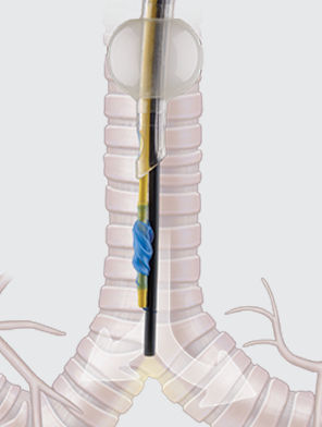 Bloccatore endobronchiale a doppio lume - COOK Medical - monolume
