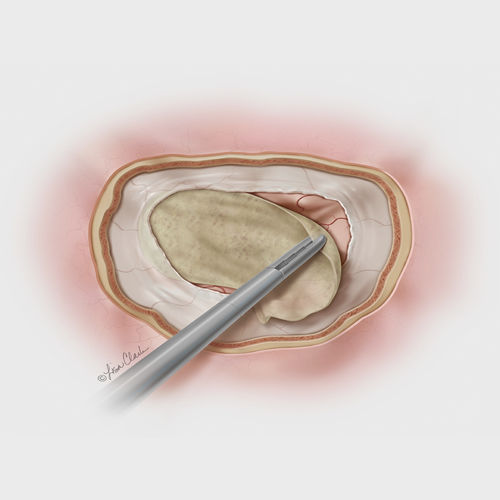 Protesi di sostituzione della dura madre sottomucosa di intestino porcino - Biodesign® - COOK Medical