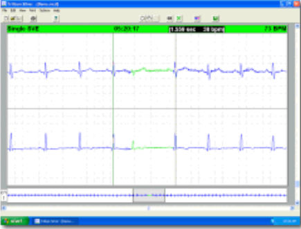 Software di monitoraggio - Trillium Silver™ - Forest Medical - di analisi / medico / per Holter cardiaco