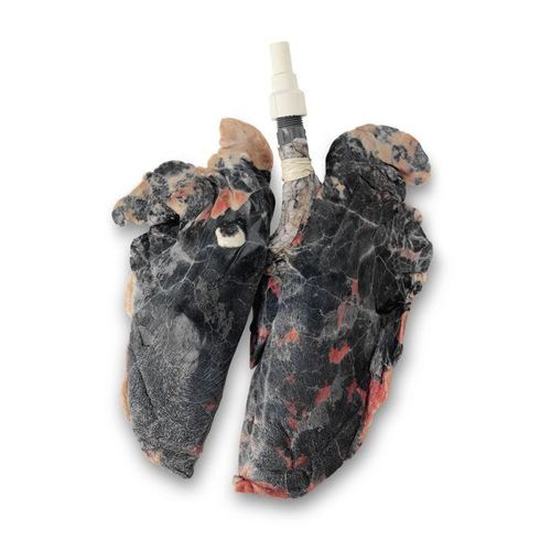 Modello anatomico di polmone - LS03766 - Nasco - con effetti del tabagismo