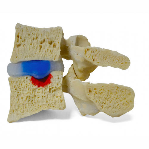 Modello anatomico di dischi intervertebrali - Schmorl’s  - Dynamic Disc Designs Corp. - di ganglio linfatico / ad uso didattico