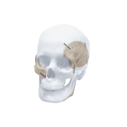 Impianto cranico su misura - TRUMATCH™ - Depuy Synthes