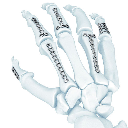 Placca di compressione per metacarpo - LCP® - Depuy Synthes - bloccata / in metallo