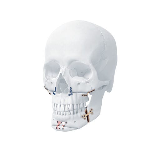 Placca di compressione per mandibola - MatrixORTHOGNATHIC™ - Depuy Synthes - per mascella / bloccata / in metallo