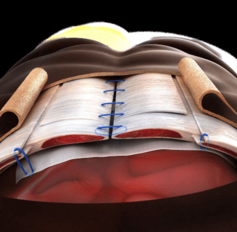 Matrice tissutale chirurgia ortopedica - XCM Biologic™ - Depuy Synthes