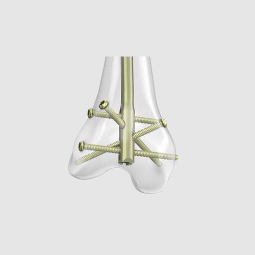 Chiodo intramidollare per femore - RFN-ADVANCED™ - Depuy Synthes - fissazione distale / in metallo
