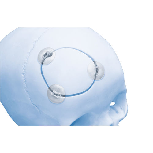 Sistema di fissazione cranica assorbibile - RAPIDSORB™  - Depuy Synthes