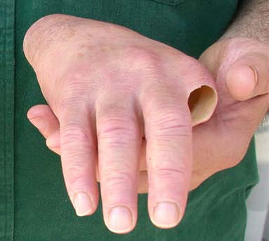 Protesi estetica mano - Aesthetic Prosthetics - di parziali / per adulti