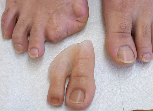 Protesi estetica alluce - Aesthetic Prosthetics - per adulti