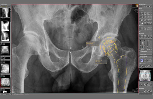 Modulo software di pianificazione - dicomPACS® Prosthesis  - OR Technology - Oehm und Rehbein - per diagnostica per immagini / per chirurgia ortopedica