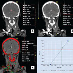 Modulo software medico - Aquarius iNtuition - TeraRecon - per imaging cerebrale / diagnostico / con sistema di tracciatura