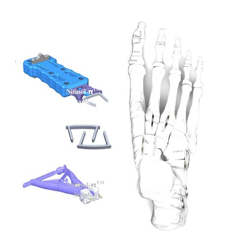 Graffa ortopedica per piccoli frammenti ossei - HJ-π Staple - Health-Joy Medical - per alluce valgo / per artrodesi dell'articolazione interfalangea del piede / per osteotonomia di Evans del calcagno