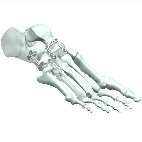Placca per artrodesi per articolazione tarso-metatarsica - HJ-Expandable 01 - Health-Joy Medical - laterale / distale / dorsale