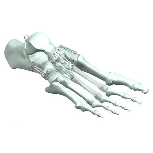 Placca per artrodesi per articolazione metatarso-falangea - HJ-Expandable 02 - Health-Joy Medical - per articolazione tarso-metatarsica / per articolazione talonavicolare / per metatarso