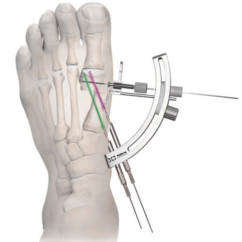 Strumentario per chirurgia mininvasiva dell'avampiede - HJ-Bunion  - Health-Joy Medical