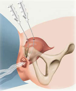 Fascetta per ricostruzione per l'incontinenza urinaria - SPARC™ - American Medical Systems - via suprapubica / per donna