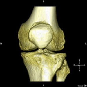 Software per la progettazione di protesi del ginocchio - iFit® - ConforMIS - di anatomia / per chirurgia ortopedica