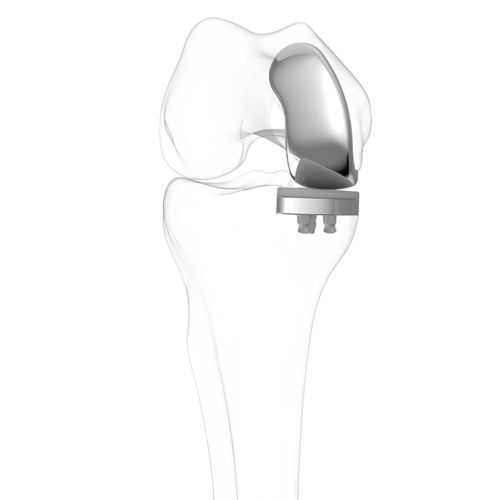 Protesi di ginocchio monocompartimentale - iUni®  - ConforMIS - a piatto fisso / cementata