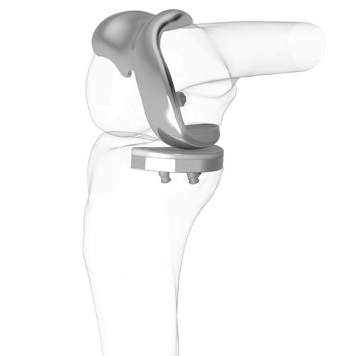 Protesi di ginocchio monocompartimentale - iDuo®  - ConforMIS - a piatto fisso / cementata
