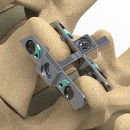 Impianto vertebrale interspinale lombare - Reli™ SP - Precision Spine - sacrale / toracico